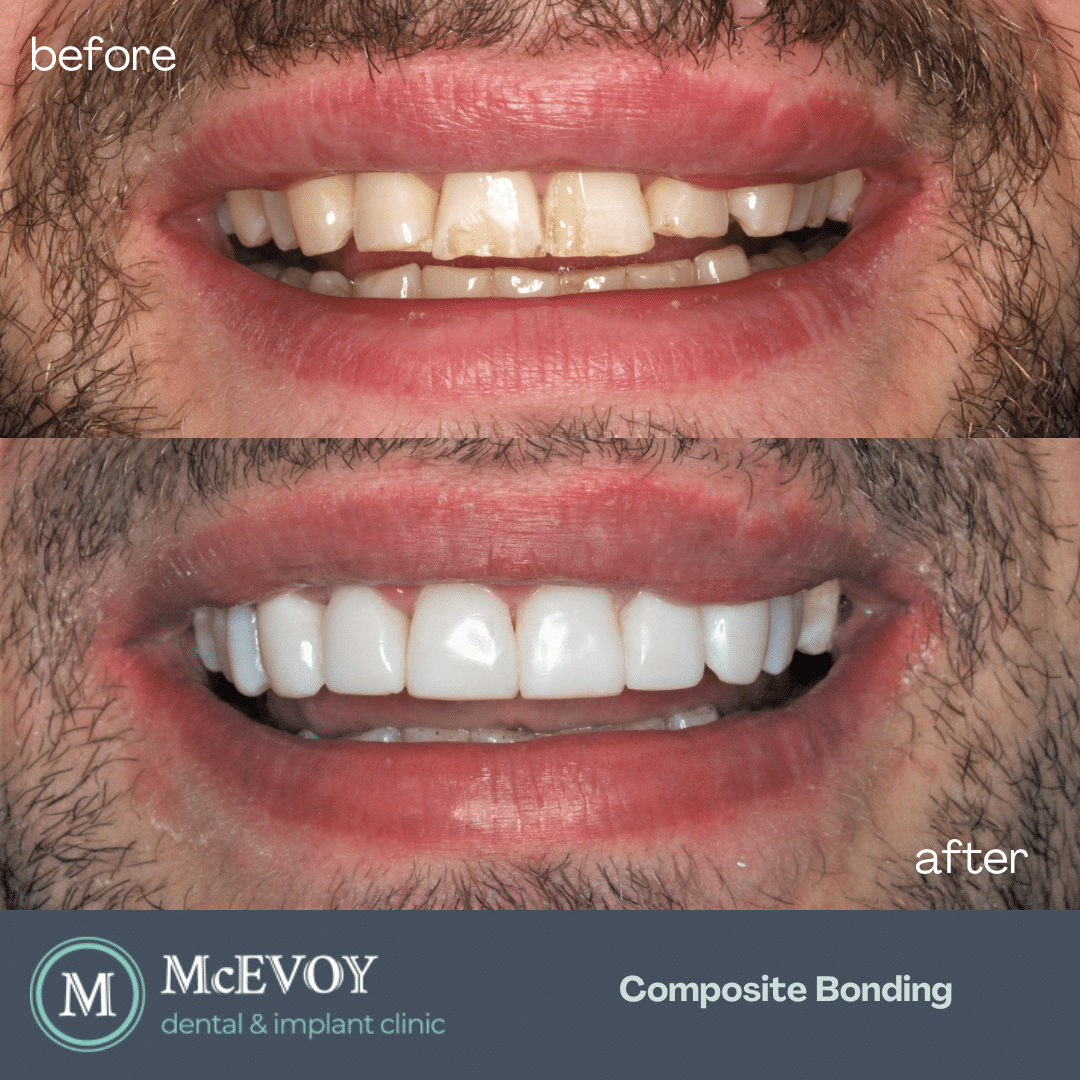 Composite Bonding Dublin McEvoy Dental