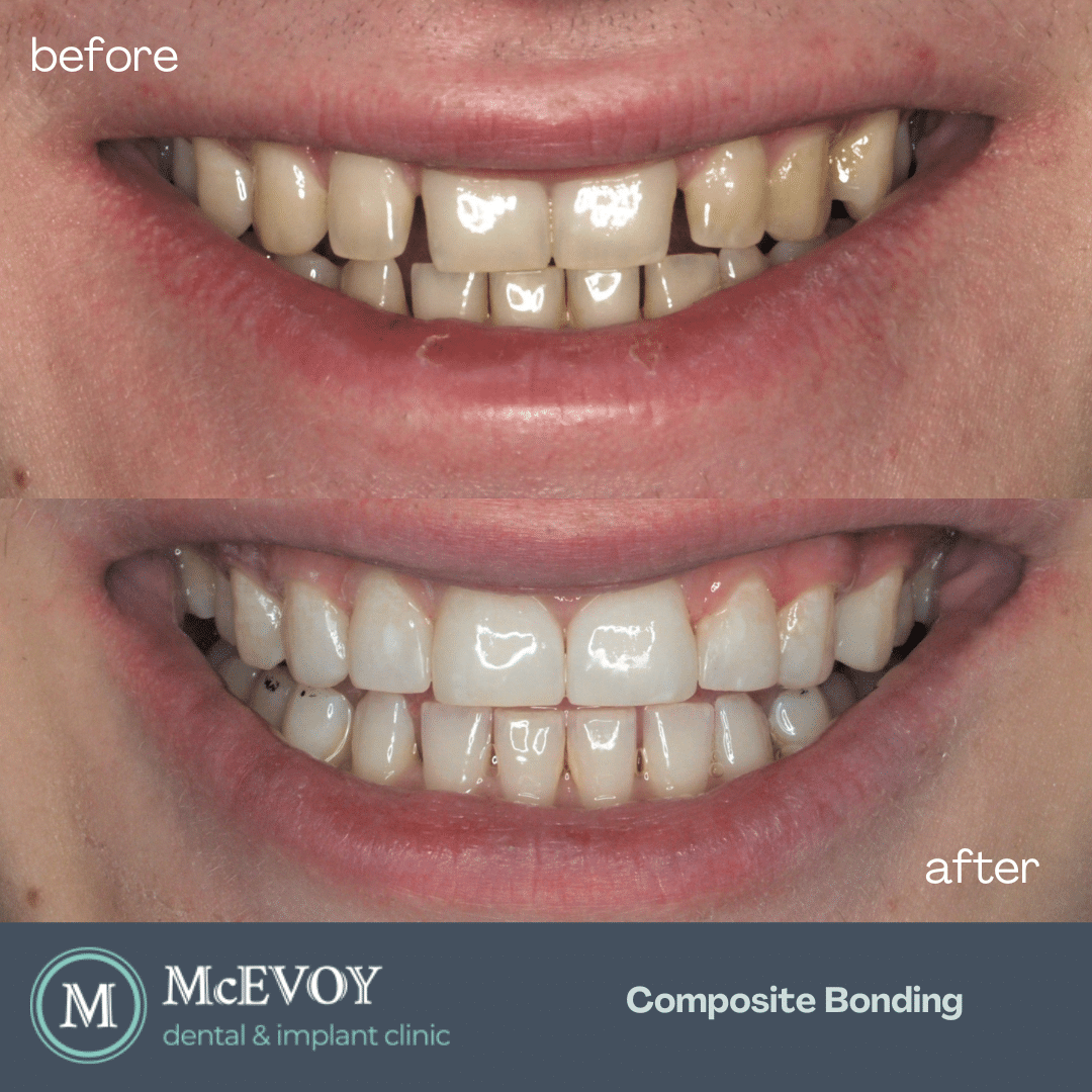 Composite Bonding Dublin - McEvoy Dental
